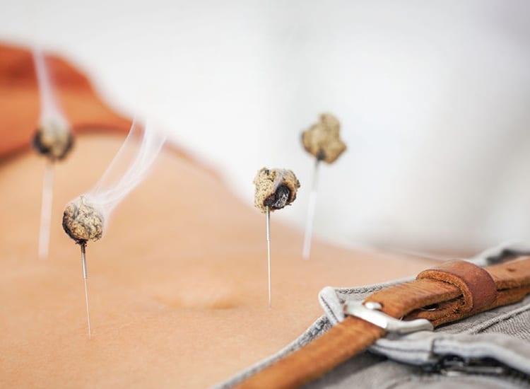 5 Remarkable Benefits Of Acupuncture