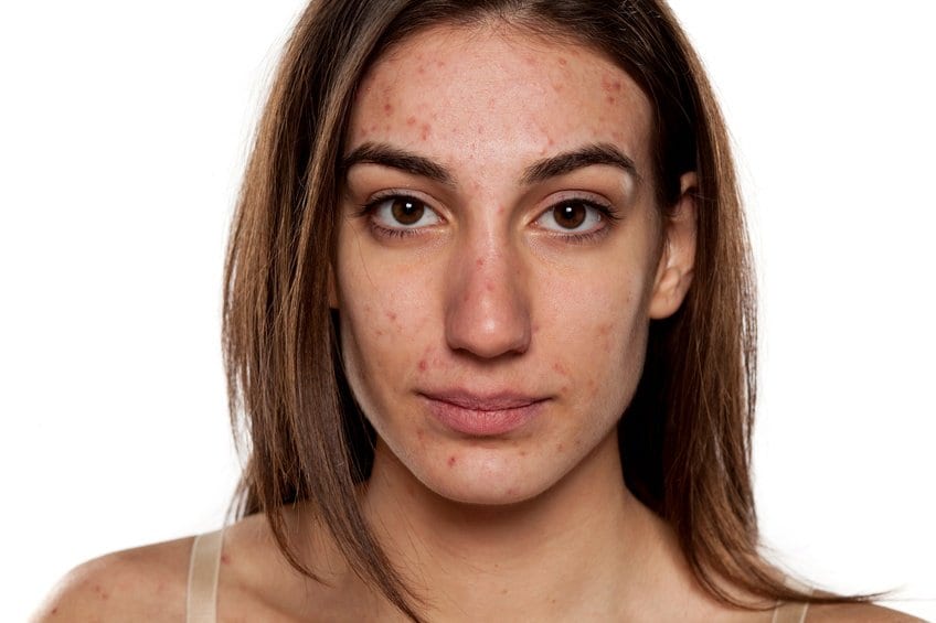 The Most Common Types Of Acne And How To Deal